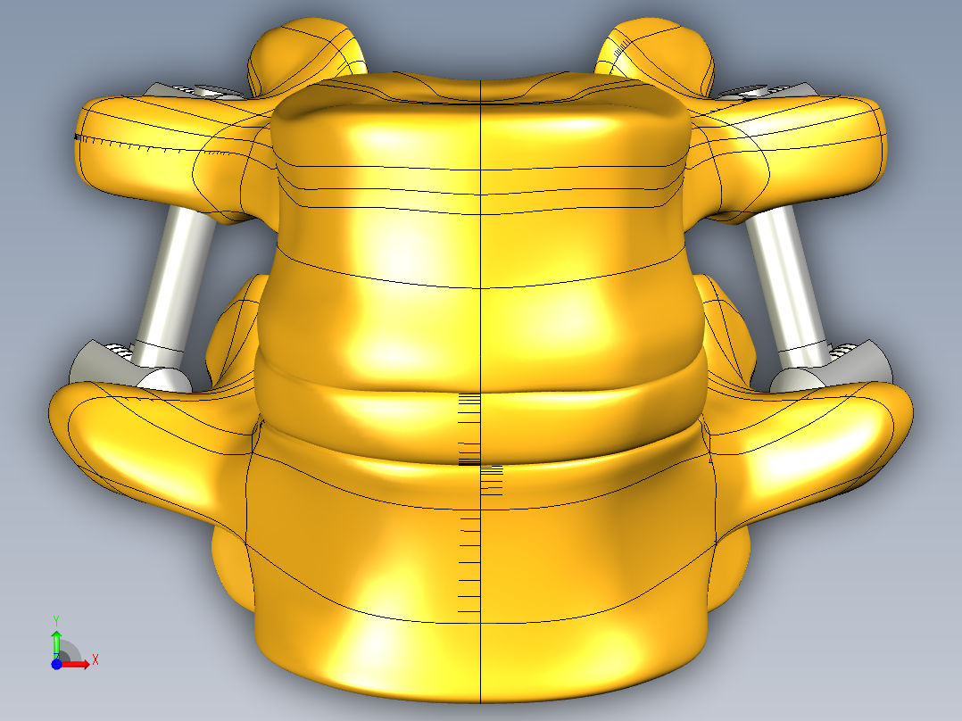 椎弓根螺钉系统前视图