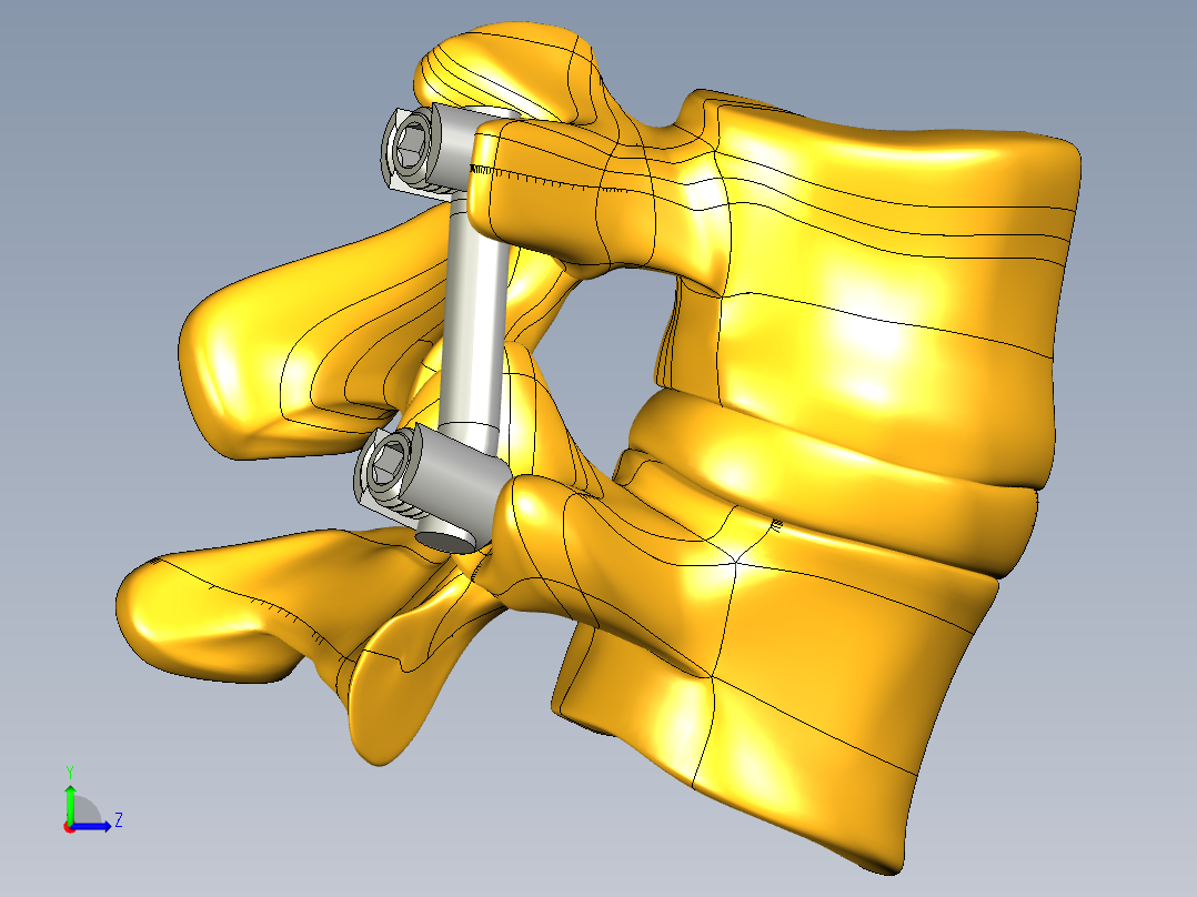 椎弓根螺钉系统左视图
