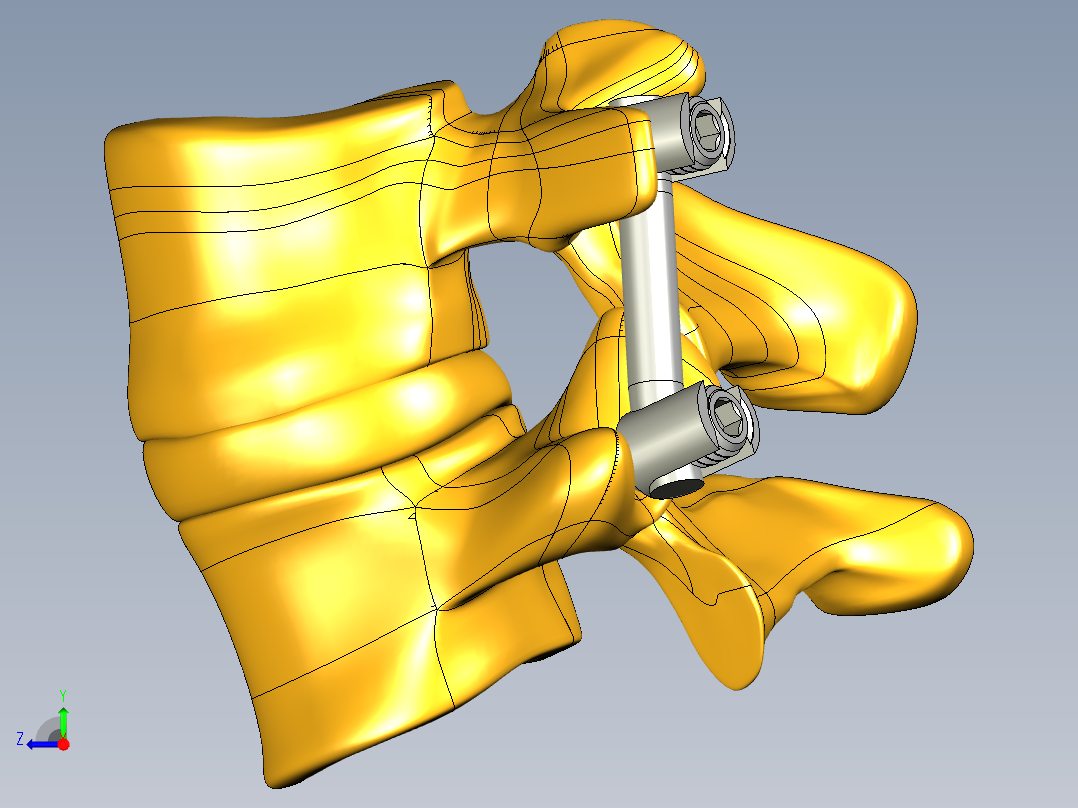 椎弓根螺钉系统右视图