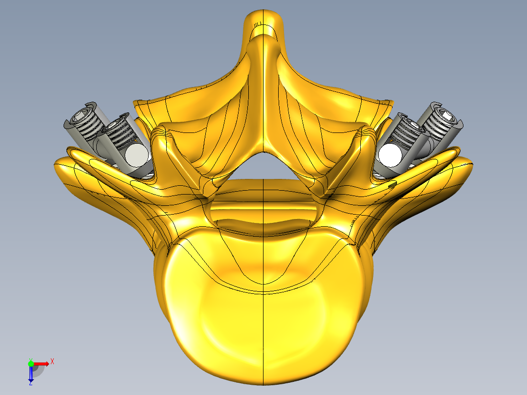 椎弓根螺钉系统俯视图