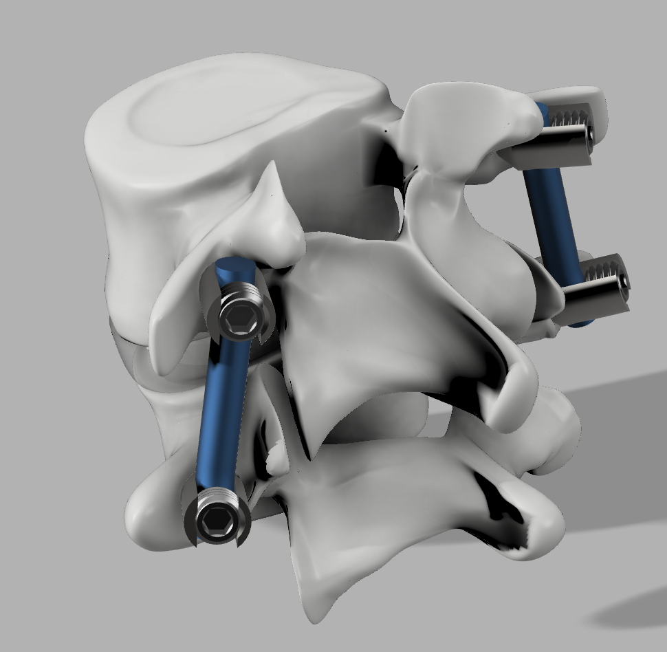 椎弓根螺钉系统